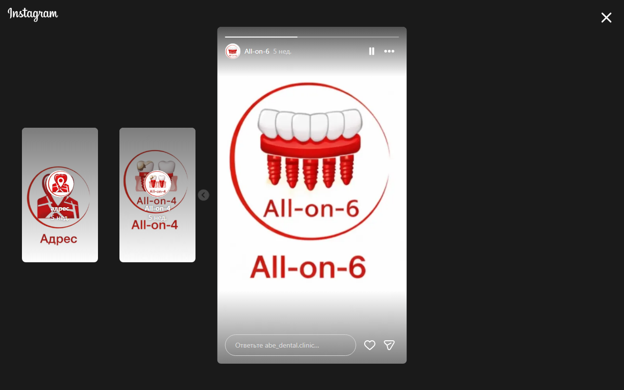 All-on-6 протезирование