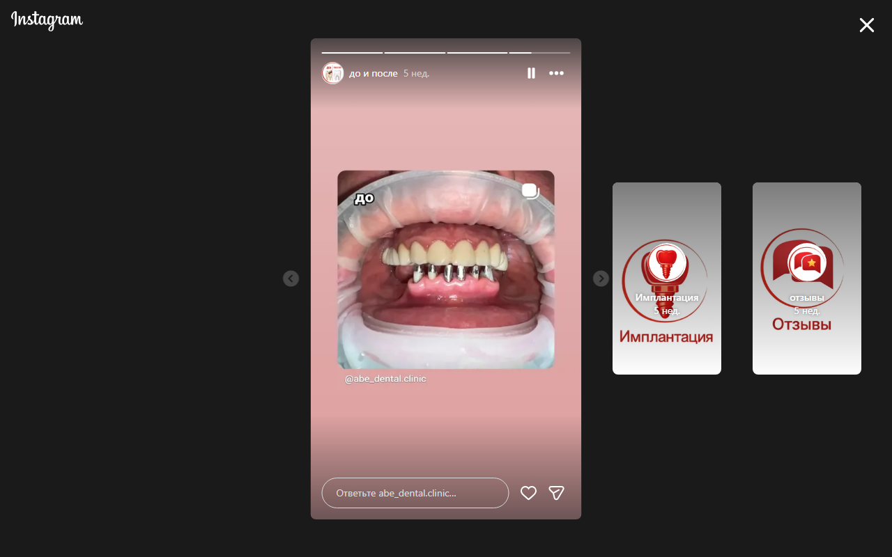 Процесс имплантации