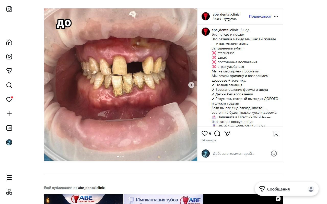 До — металлические коронки