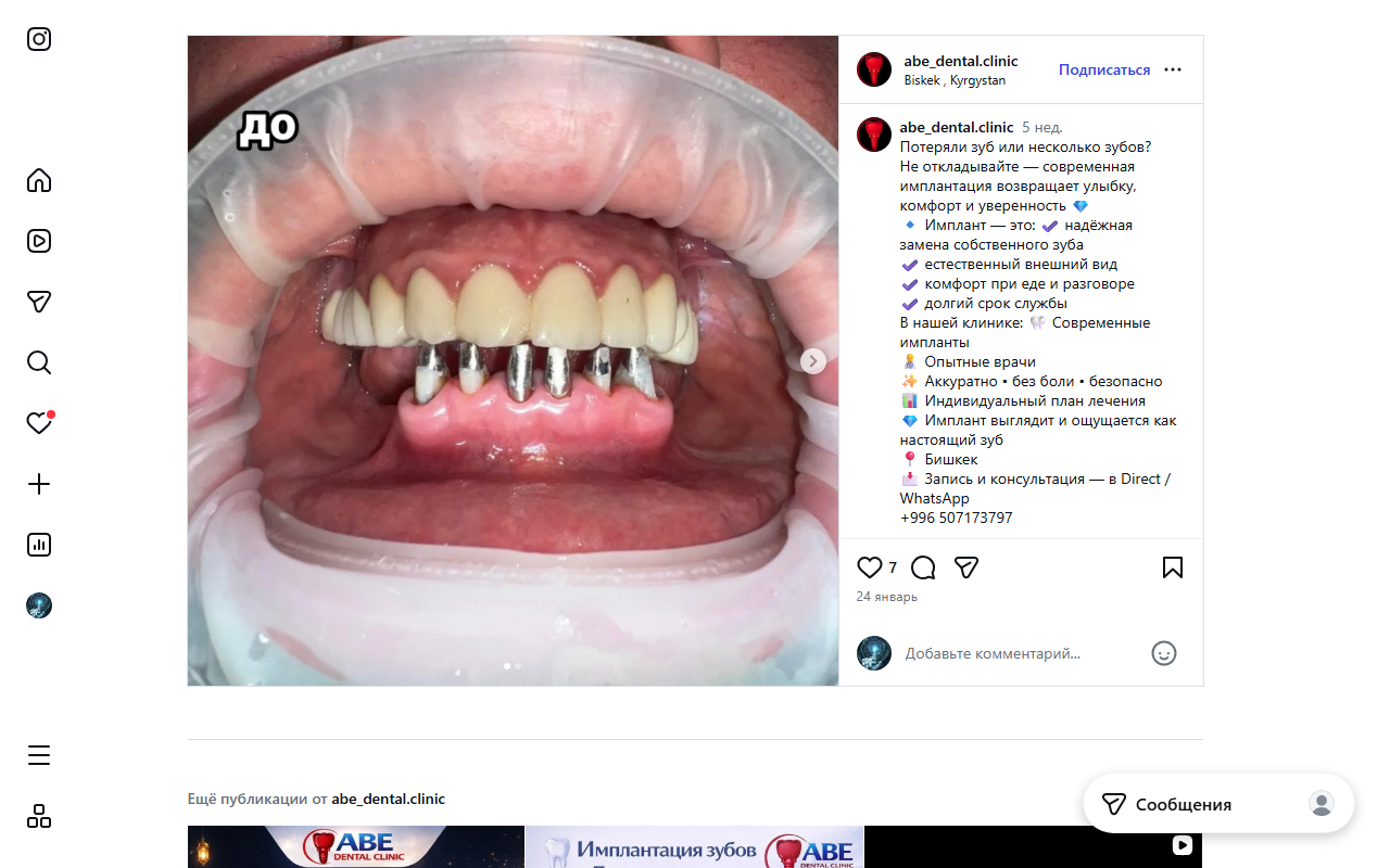 Кейс имплантации